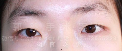 双眼皮开眼角明星,揭秘美丽蜕变之路